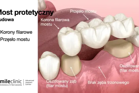 Most protetyczny z przęsłem i koronami filarowymi, uzupełniający brak 2 zębów obok siebie.