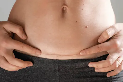Ärr efter akut kejsarsnitt syns på magen.