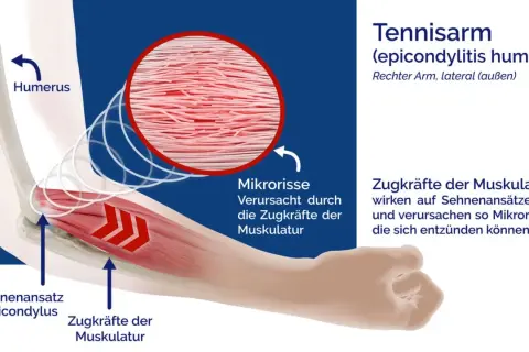 Illustration zeigt den rechten Ellenbogen bei einem Tennisarm. Zugkräfte der Muskulatur verursachen Mikrorisse am Sehnenansatz.