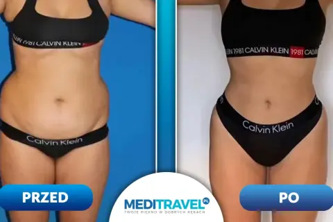 Przed i po liposukcji laserowej. Zobacz, jak zmieniła się sylwetka. Sprawdź, jaka jest liposukcja laserowa cena i zacznij swoją metamorfozę!