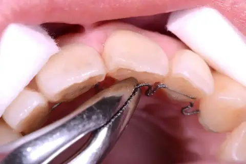 Dettaglio di un apparecchio ortodontico che lavora sullo spazio tra i denti laterali, con cotone per isolare.