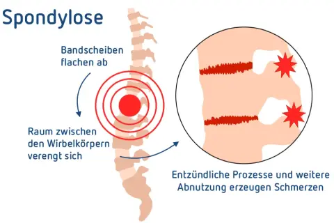 Spondylose LWS: Bandscheiben flachen ab, Raum zwischen Wirbelkörpern verengt sich. Entzündliche Prozesse und Abnutzung erzeugen Schmerzen.