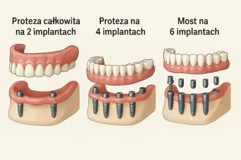Ilustracja pokazuje trzy rodzaje protez dentystycznych: całkowitą na 2 implantach, na 4 implantach oraz most na 6 implantach.