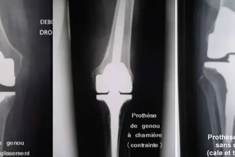 Radiographies de genoux avec prothèses. La question "peut on s'accroupir avec une prothèse du genou" est illustrée par différents types de prothèses.
