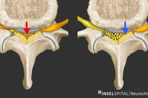 Vergleich: Spinalkanalstenose LWS mit Druck (rot) vs. Entlastung (blau). Die Darstellung zeigt, wie sich die Nervenwurzeln bei einer Spinalkanalstenose LWS verhalten.