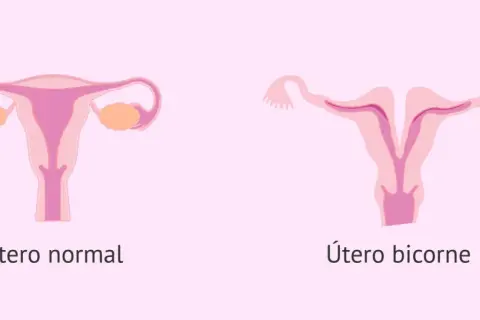 Comparación visual de un útero normal y un útero bicorne, mostrando la forma dividida de este último.