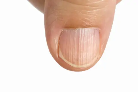 Dettaglio di un pollice con unghie rigate verticalmente, che mostrano una texture naturale e delicata.