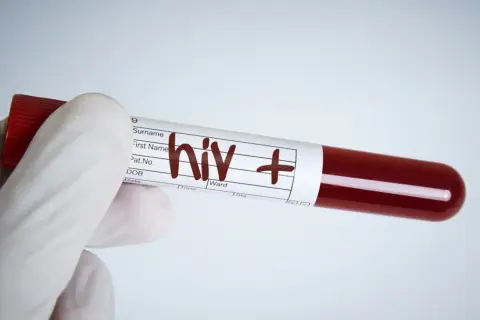 Rękawiczka medyczna trzyma probówkę z krwią oznaczoną "hiv +". Wynik testu na aids jest pozytywny.