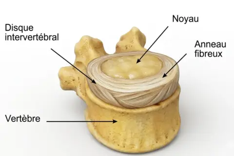 Disque intervertébral, noyau et anneau fibreux, montrant la structure d'une vertèbre, essentielle pour comprendre une hernie discale.