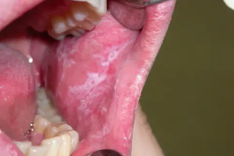Bocca con leucoplachia, macchie bianche sulla mucosa interna. La buona notizia è che la leucoplachia si guarisce con le giuste cure.