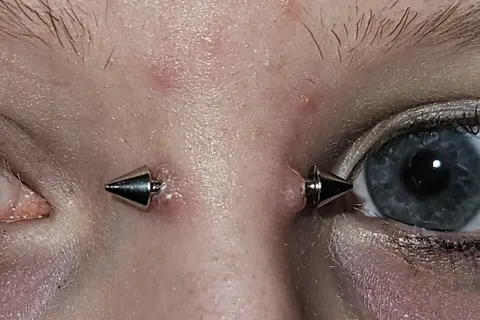 Oko z piercingiem bridge, ozdobionym dwoma metalowymi stożkami. Skóra wokół jest lekko zaczerwieniona.