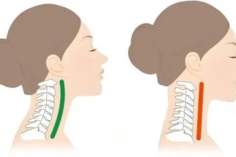 Illustration visar en halsryggrad med en grön markering som indikerar en normal kurva, och en röd markering som visar en rakare nacke, potentiellt relaterat till cervikal spondylos.
