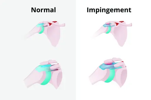 Schultergelenk: Normal vs. Impingement. Die obere Reihe zeigt eine gesunde Schulter, die untere zeigt das Impingement-Syndrom, das Schmerzen bei bestimmten Schlafpositionen verursachen kann.