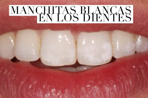 Primer plano de una boca mostrando dientes con manchas blancas.
