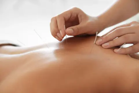 Main d'acupuncteur plaçant des aiguilles sur le dos d'une personne. L'acupuncture effet au bout de combien de temps ?