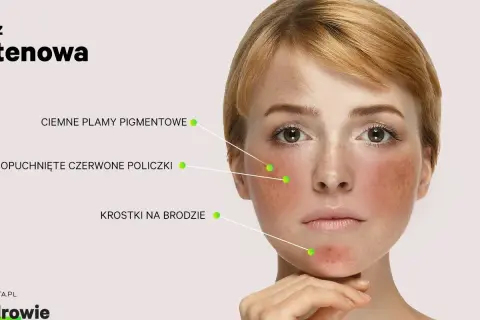 Twarz młodej kobiety z zaczerwienionymi policzkami, ciemnymi plamami i krostkami na brodzie. Objawy celiakii i nietolerancji glutenu.