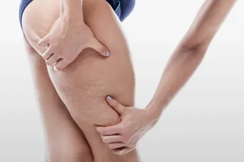 Mani che stringono la coscia, evidenziando la pelle con segni di cellulite, forse un effetto di 10 kg di ritenzione idrica.