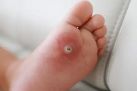 Małe, okrągłe zgrubienie na stopie dziecka, które wygląda jak kurzajka. Skóra wokół jest lekko zaczerwieniona.
