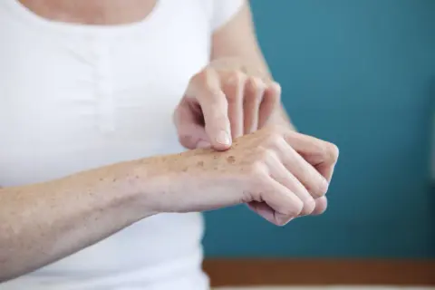 Una persona se señala las manchas en las manos, mostrando la piel con pecas y marcas de sol.