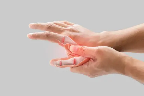 Main d'une personne montrant des articulations enflammées et une douleur extérieure au poignet, avec une visualisation des os.
