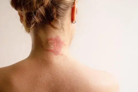 Roter, schuppiger Ausschlag am Nacken, der auf Neurodermitis hindeutet. Suche nach Neurodermitis Hausmittel zur Linderung.