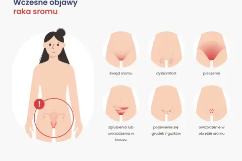Ilustracja przedstawia wczesne objawy raka sromu: świąd, pieczenie, dyskomfort, owrzodzenia i grudki.