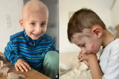 Ein Junge mit Glatze spielt mit Knete. Ein anderes Bild zeigt ihn mit Narben am Kopf, was auf eine Behandlung von Neuroblastom hindeutet.
