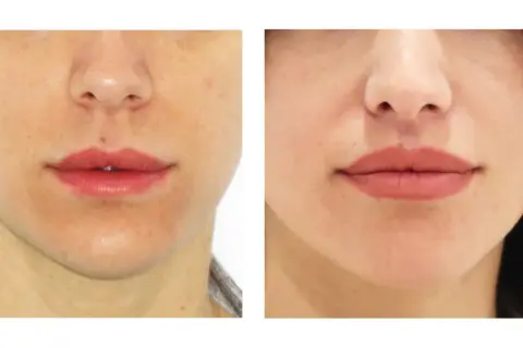 Antes y después de un lip lift: los labios se ven más definidos y voluminosos, logrando un aspecto más juvenil.