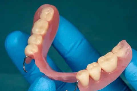 Proteza na NFZ Warszawa. Dentyści w niebieskich rękawiczkach prezentują protezę zębową z metalowymi zaczepami.