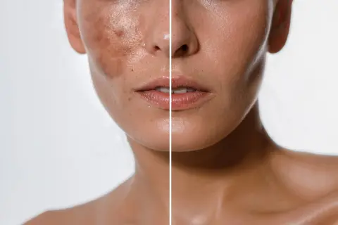 Comparación de piel antes y después de tratamientos despigmentantes, mostrando una reducción visible de manchas y un tono más uniforme.