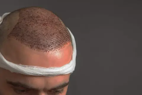 Hombre con vendaje en la cabeza tras trasplante capilar. Se aprecian los injertos para un pelo normal.