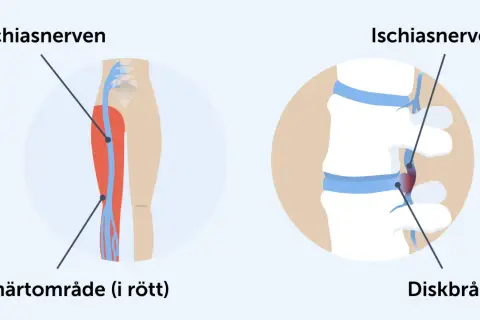 Illustrationer visar var ischiasnerven sitter, dess smärtområde i benet och hur ett diskbråck kan påverka den.