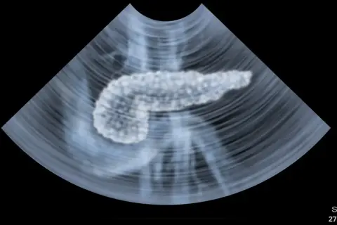 Ultraschallbild einer Bauchspeicheldrüse. Die Pankreas Untersuchung zeigt das Organ in detaillierter Ansicht.