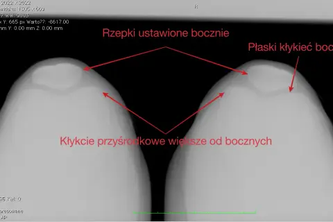 Zwichnięcie rzepki: ile trwa rehabilitacja? Od 4 tyg. do roku