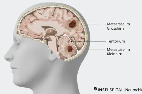 Schnitt durch ein Gehirn mit Metastasen im Großhirn und Kleinhirn. Die Darstellung zeigt, wie Metastasen im Kopf das Leben beeinflussen können.