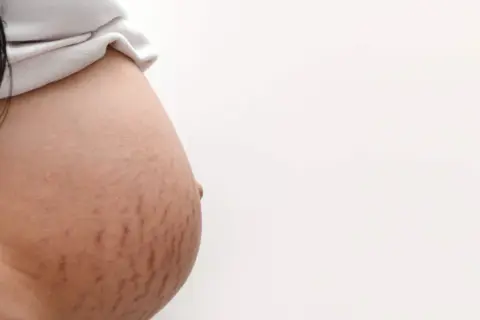 Czerwone rozstępy na brzuchu kobiety, świadectwo pięknej podróży macierzyństwa.