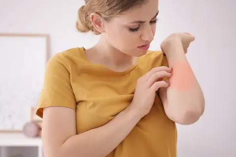Alergia na roztocza: objawy skórne, AZS i jak sobie z nimi radzić
