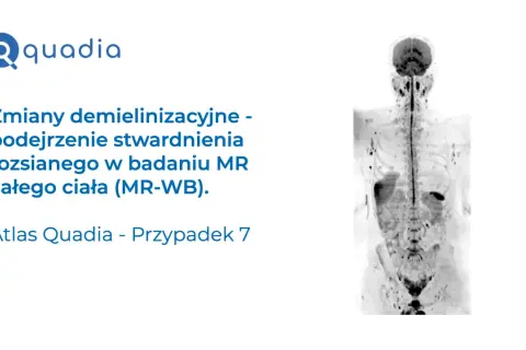 Badanie MR całego ciała wykazało zmiany demielinizacyjne, sugerujące stwardnienie rozsiane. Atlas Quadia, przypadek 7.