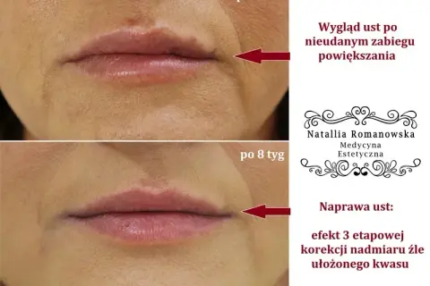 Kiedy można się całować po powiększaniu ust? Uniknij ryzyka infekcji