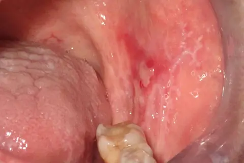 Lesioni biancastre e rosse nella bocca, indicative di lichen planus orale, in attesa di terapia.