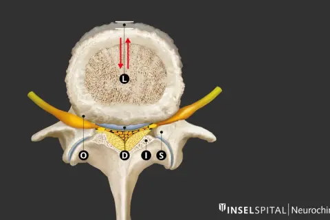 Querschnitt einer Wirbelsäule mit Darstellung der neuroforaminalen Enge. Ein Nerv (gelb) wird durch knöcherne Strukturen und Gewebe eingeengt.