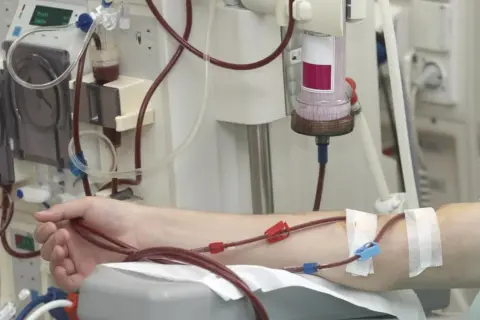 Ramię pacjenta podłączone do aparatury do dializy otrzewnowej. Czerwone wężyki prowadzą krew do oczyszczenia.