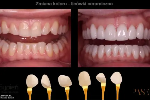 Przed i po metamorfozie zębów: od naturalnego koloru do olśniewającego, hollywoodzki uśmiech dzięki licówkom ceramicznym.