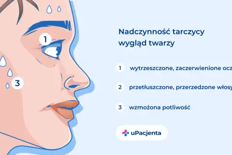 Nadczynność tarczycy: wytrzeszczone oczy (1), przetłuszczone włosy (2), wzmożona potliwość (3).
