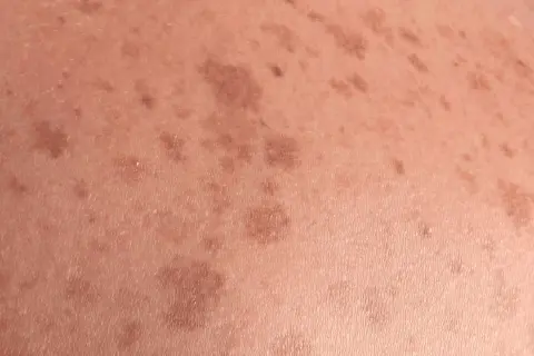 Piel con manchas marrones irregulares, indicativas de lentigo solar, resultado de la exposición al sol.