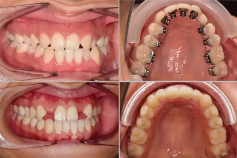Denti con agenesia e apparecchio ortodontico. Valutare i costi per risolvere l'agenesia dentale.