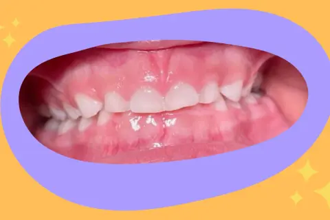 Primo piano dei denti di un bambino con un morso aperto, mostrando gli incisivi superiori e inferiori separati.