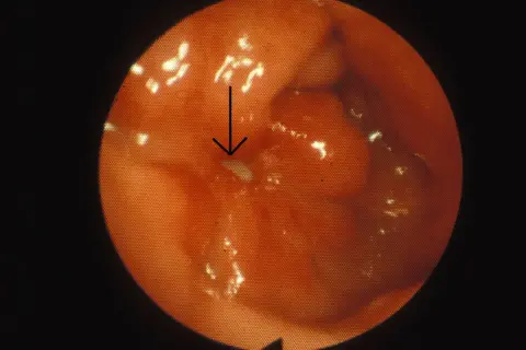 Endoskopisk bild av magsäcken visar rodnad och svullnad, tecken på inflammation magsäcken. En pil pekar mot en liten vit fläck.