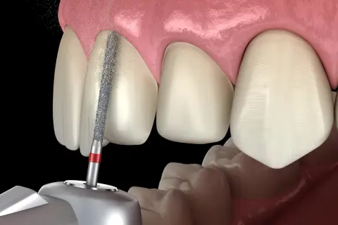 Dettaglio di un dente sottoposto a stripping denti. Considerare le controindicazioni prima di procedere.