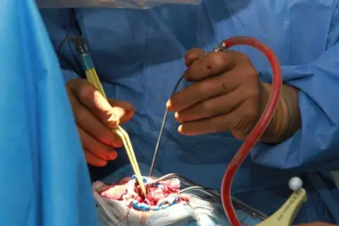 Chirurgen führen eine Hirntumor-OP durch. Hände mit Instrumenten arbeiten präzise am Gehirn.